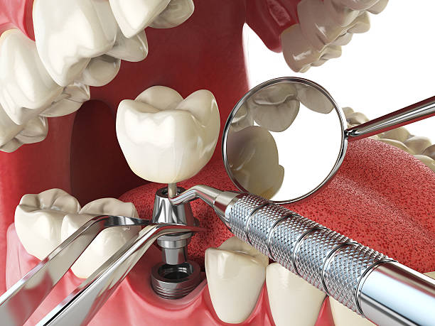 Best Emergency Tooth Extraction in Diamondhead, MS